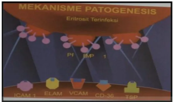 Gambar 5. Mekanisme knop eritrosit terinfeksi dengan reseptor PfEMP-1 yang akan mengalami sitoadhesi pada molekul adhesi di endotel 