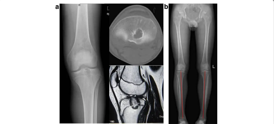 Fig. 6 A 13-year-old boy’s X-ray, CT, and MRI (a) showed the lesion located at the proximal tibia