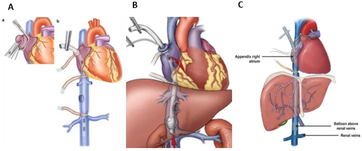 Figure 7A/B -Atrial opening with balloon passage through the inferior vena cava. 7C - Atriocaval shunt functioning after fixation of the tube in the atrium and infrahepatic inferior vena cava with an inflated balloon                                                                                              Source: https://link.springer.com/chapter/10.1007/978-1-4939-1200-1_10    