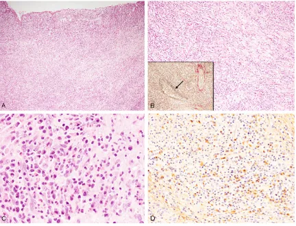 Figure 3. Histopathological and immunohistochemical features of the gallbladder. A: Dense lymphoplasmacytic infil-tration is observed in the entire gallbladder wall, HE, x 40