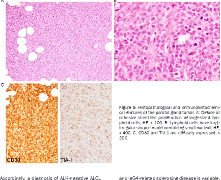 Figure 5. Histopathological and immunohistochemi-cal features of the parotid gland tumor