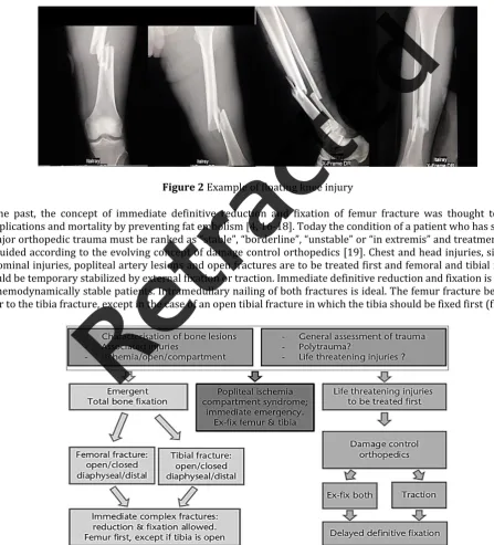 Figure 2 Example of floating knee injury In the past, the concept of immediate definitive reduction and fixation of femur fracture was thought to reduce complications and mortality by preventing fat embolism [4, 16-18]
