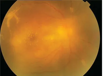 Fig. 1. Retinal examination showed perivascular sheathing with frosted branch angiitis pattern in veins and patchy retinal hemorrhages.