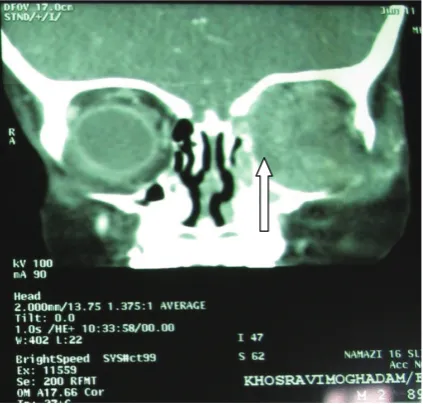 fig. 2. Swelling of upper and lower lid in the patient with mucormycosis  Computer tomography scan of the orbits of patient 