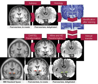 Fig. 1.Postmortem MRI processing. Identification of the basal forebrain cholinergic system