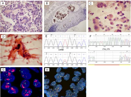 Figure 1. Images of the most frequent histological and molecular results [A: Adenocarcinoma, papillary subtype (HE, 400 x), B: Embolism of adenocarcinoma cells in the lymphatic vessel (TTF-1, 100 x), C: Adenocarcinoma with visible droplets of intracytoplasmic mucus (HE, 400 x), D: Squamous cell carcinoma (HE, 1000 x), E, F: Graphical illustra-tion of EGFR gene mutations: exon 21 substitution (L858R) and exon 19 deletion (E746_A750) respectively, G, H: FISH positive results: amplification (1000 x) and high polysomy (600 x)].