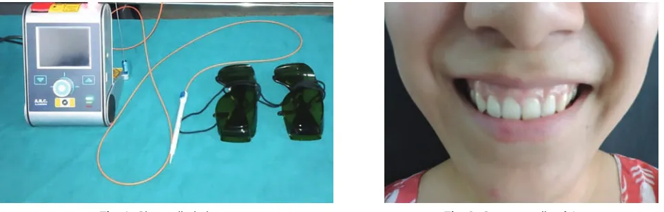 Fig. 1: Sirona diode laser