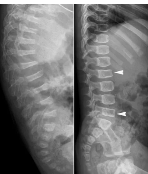 Fig. 8 Lateral radiographs of the spine in two children with OI exhibitsevere and multiple vertebral collapses associated with kyphosis (left)and less severe collapses of the vertebral bodies (arrowheads) (right).Osteopenia is much more pronounced on the left