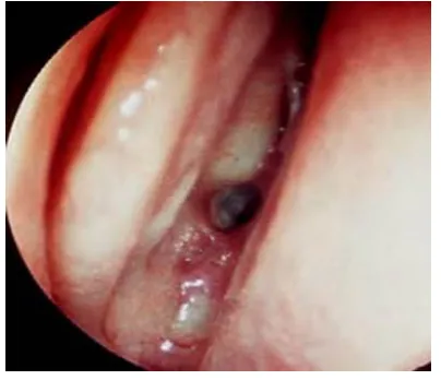 Figure 2. After removing the bone between the sphenoid os-tia, a wide endoscopic exposure of the sella turcica is attained