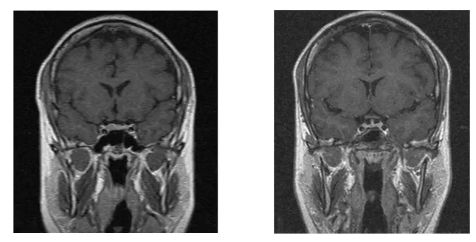 Figure 3. a) Coronal T1W enhanced MRI sequence through the sella turcica showing a right sellar hypoenhancing nodule sug-gestive of pituitary microadenoma in a patient with Cushing’s disease, b) Post-operative MRI showing no residual adenomaThe patient had biochemical remission as well.