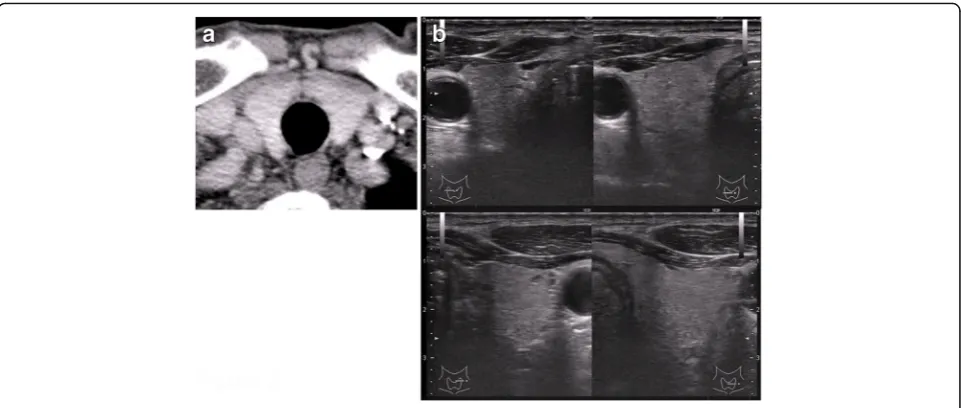 Fig. 3 a, b 18F-Fluorodeoxy glucose positron emission tomography revealed positive accumulation of FDG in the left buttock mass (SUV MAX 6.2)but was negative in other locations, including the thyroid gland