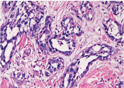 Fig. 1: Adenoid squamous cell carcinoma (Courtesy: Terada T. Int J Clin Exp Pathol 2012;5(5):442-447)