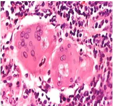 Fig. 10: Conchoid (Courtesy: Ang SC, Moscovic EA. Histol Histopathol 1996 Jan;11(1):125-134)