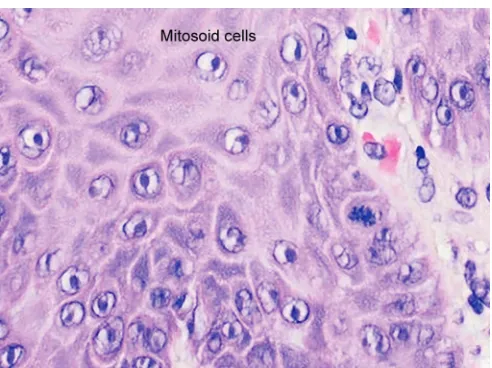 Fig. 19: Mucinoid (Courtesy: Regezi JA, Sciubba JJ. Oral pathology, clinical pathologic correlations