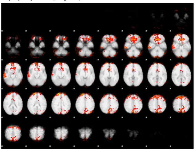 Figure 7. The average of group on 12 patients by joint detection estimation method based on functionally homogenous regions for optimal contrast (craving>neutral).