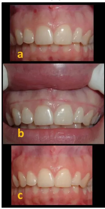 Fig. 1: High lip line with excessive gingival exposure; (a)     before, (b) after esthetic crown lengthening 