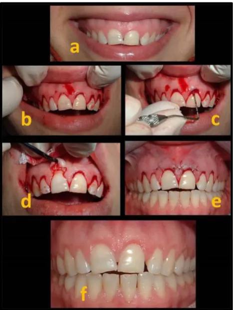 Fig. 7: Esthetic crown lengthening; (a) before, (b+c) gingival excision, (d) alveolar bone exposure, (e) after bone 