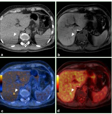 Fig. 3 Comparison of PET/CTliver vein. The lesion is onlydetectable in co-registered PET/CT images (on unenhanced low-dose CTaxial images (and PET/MRI of a patientshowing superiority of MRIversus CT