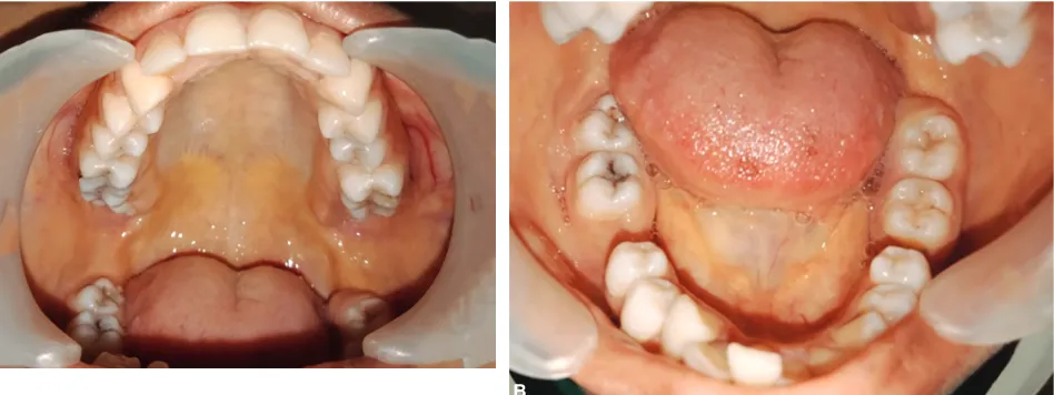 Fig. 4: Panoramic radiograph showing enlarged marrow spaces and residual cyst irt missing 36