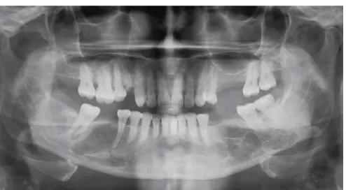 Fig. 7: Orthopantomograph showing process of bone repair 