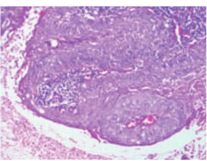 Fig 4. Ameloblastic differentiation with marked cellular atypia, showing loss of  peripheral palisading or nuclear polarity and inflammatory component.