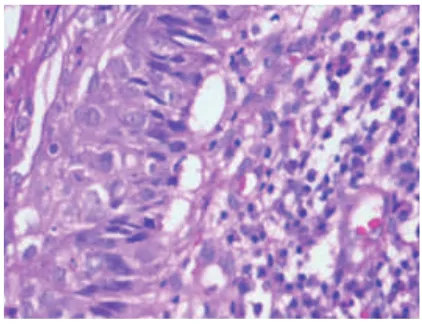 Fig 7. A satellite island of  cells  showing squamous metaplasia admist inflammatory cells and blood component mimicking squamous cell carcinoma 