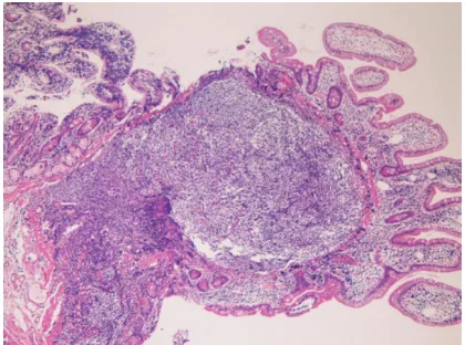 Figure 4. Hyperplastic polyp of the duodenum. Hyper-plasia of gastric foveolar-like cells is recognized