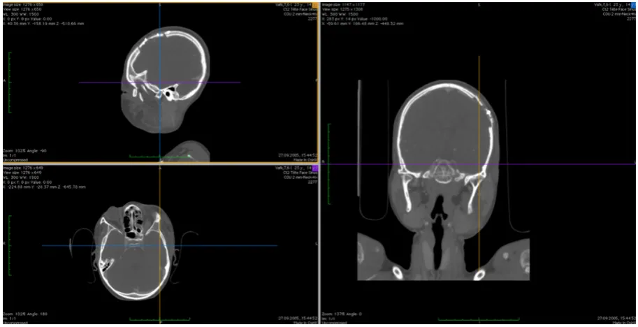 Fig. 1. Virtual model of a skull with and without the implant (a) and photography of an exemplary training physical model of the same skull with two physical models of implants made by author using 3D printing (b)All illustrations of the human skull in the article are based on the 3D digitization of their physical educational models.