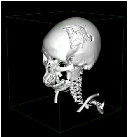 Fig. 3. View of the STL mesh models of human skull (made from DICOM files) after partial neurosurgical reconstruction [18]