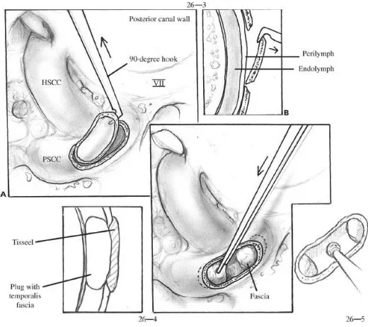 Fig 15: Posterior semicircular canal occlusion(90) 