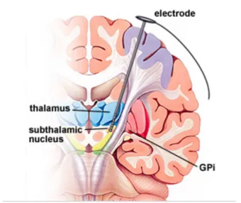 Figure 2.5. Cross-section of the brain showing DBS electrode placement in the sub 