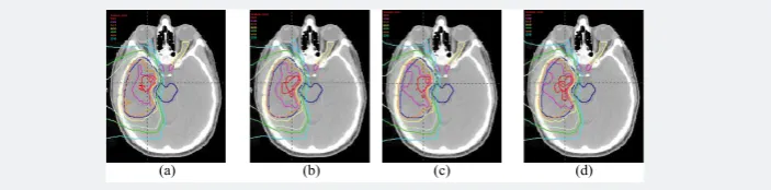 Figure 2: Iso-dose distributions of FRBE( a) and VRBE (b) for SFO IMPT plan, and FRBE (c) and VRBE (d) for MFO 