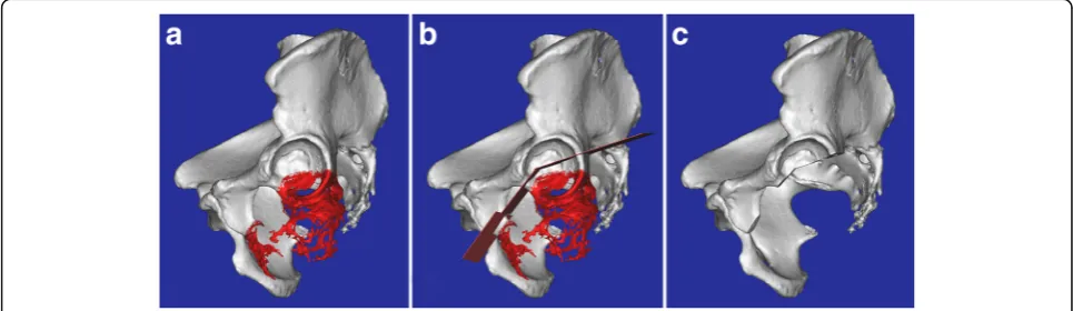 Fig. 1 a The 3D model of the pelvic bone shows the relationship between the tumor and the acetabulum