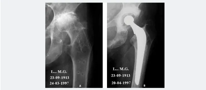 Figure 1AB: Left hip: severely handicapping coxarthrosis. B) Sir J. Charnely’s total prosthesis