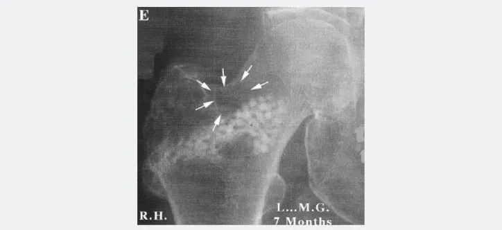 Figure 2E: 7 months follow up: partial resorption of the natural coral beads is still visible.