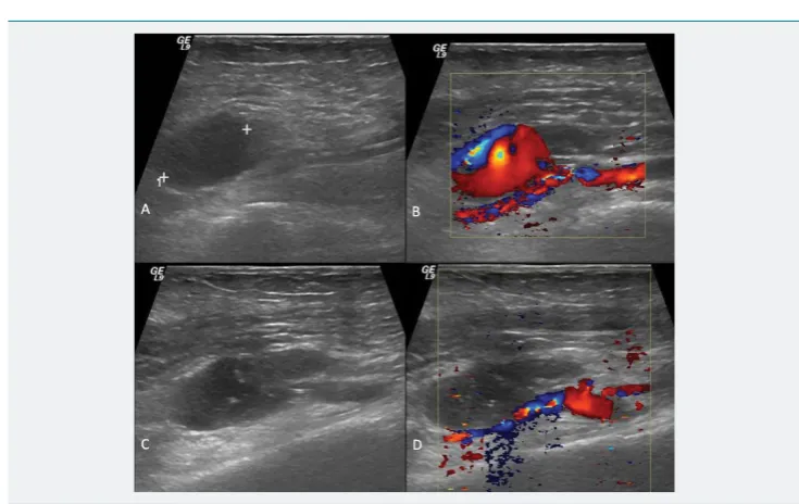 Figure 1: (A) Patient hands with ﬁ ngers extended. (B) When asked to close her hands, the patient was unable to bend the ﬁ rst and second ﬁ ngers of the right hand.