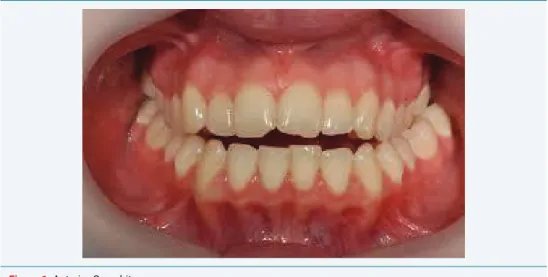 Figure 1:  Anterior Open bite.