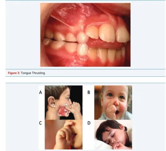 Figure 3:  Tongue Thrusting.