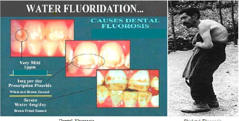 Figure 3. Dental & Skeletal Fluorosis 