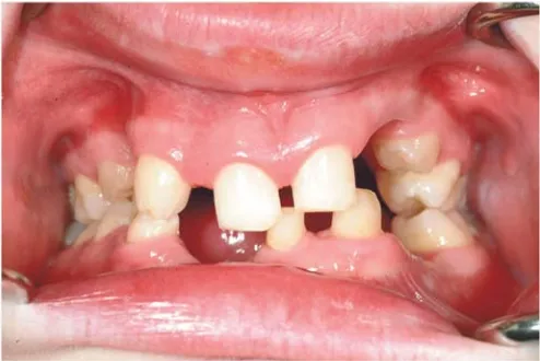 FIGURE 1: Clinical photograph of a 21-year-old male with severehypodontia. He is missing 15, 14, 12, 22, 23, 24, 25, 35, 34, 32, 41and 42 (12 in total)