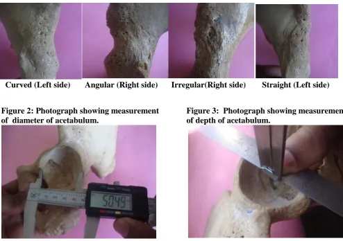 Table 1:  Comparison between the shape of  right and left anterior acetabular ridge. 
