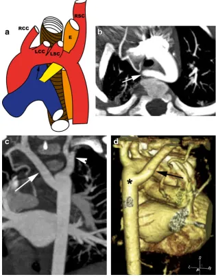 Fig. 7 Circumflex right aortic arch. a Axial CT image shows a rightaortic arch (arrow), which extends behind the oesophagus to reach theside