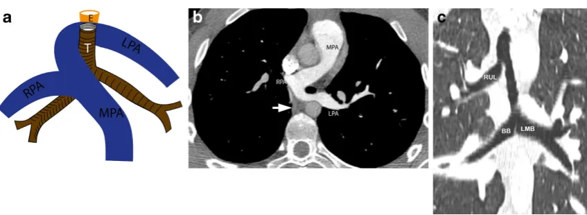 Fig. 11 Pulmonary sling. a Illustration showing an anomalous left pul-monary artery (LPA), which originates from the right pulmonary artery (RPA) and then crosses between the trachea (T) and oesophagus (E) to reachthe left