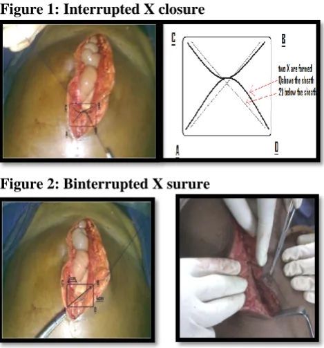 Figure 2: Binterrupted X surure 