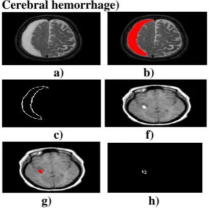 Figure 9:  a, f) input MRI of brain image; b, g) abnormality visualized by 
