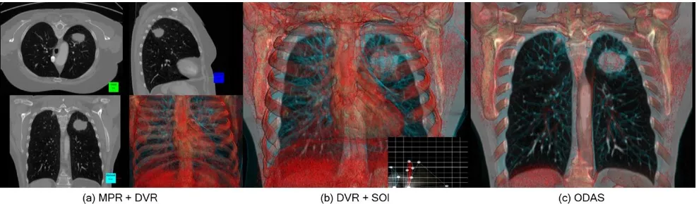 Fig. 1. Conventional direct volume rendering (DVR) of a patient study with a lung carcinoma in the left upper lobe of the lung