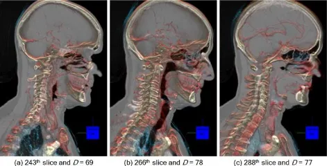 Fig. 10. Applications of TF to the ODAS with 1D TF in (b) and  2D TF in (c). In both of these renderings, the TFs were designed to highlight the lung nodule structure