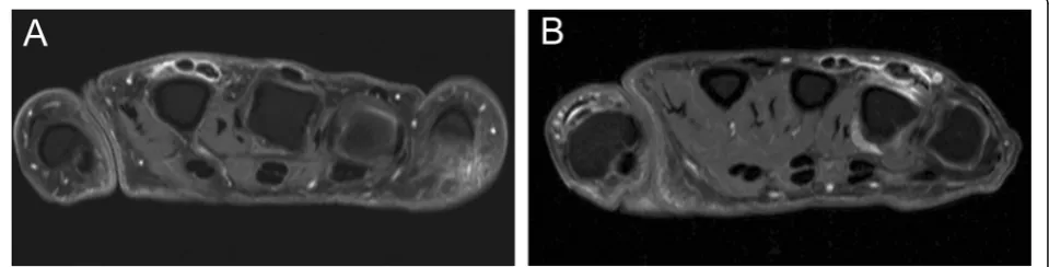 Fig.We observed that MCP-extensor peritendinitis (see 4 for an example) characteristically occurs beforethe development of clinical arthritis, in part of the RApatients