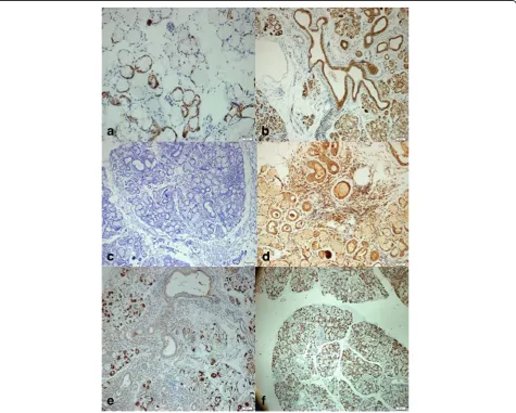 Fig. 1 Immunohistochemical staining of mTOR, PTEN, and TGF-β1 in minor salivary gland biopsies