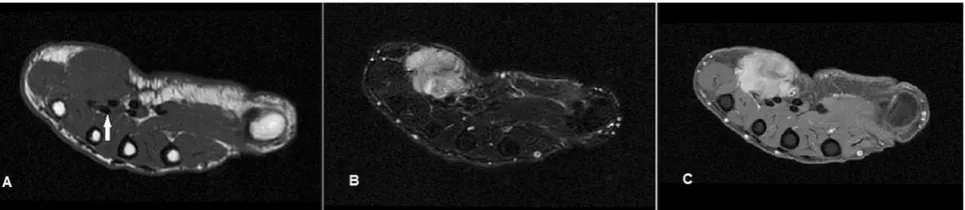 Fig. 15 Undifferentiated pleomorphic sarcoma in a 50-year-old femalepresenting with a 3-month history of a firm, fixed, enlarging lump overthe hypothenar eminence of the right hand